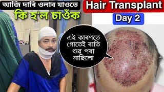 Ripunৰ Surgery পিছত কি হল চাওঁক  Day 2 Hair Transplant Journey IN ASSAM [upl. by Esiuolyram]