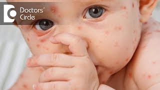 What can cause reoccurence of Chickenpox lesions amp its management  Dr Sachith Abraham [upl. by Shepp]