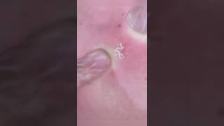 Extraction de Points Noirs Impossible à Regarder acne ytshorts blackheads [upl. by Barren]