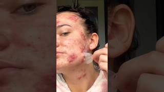 Hydrocolloid bandage the biggest acne hack 😍 acne cysticacne antiacne [upl. by Einnaej]