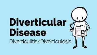 Diverticular Disease  Diverticulitis  Gastrointestinal Society [upl. by Dlonyar258]