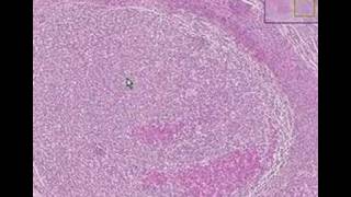 Histopathology ParathyroidTertiary hyperparathyroidism [upl. by Casia]