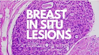 Breast In Situ Lesions Kurt’s Notes pathagonia [upl. by Leeanne246]