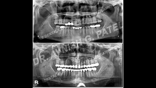 Step by step full mouth rehabilitation [upl. by Yrac]