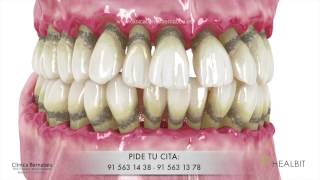 Periodoncia  gingivitis y periodontitis o quotpiorreaquot [upl. by Asial409]