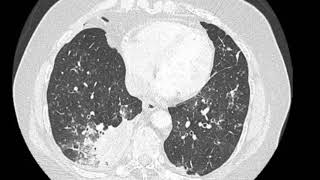 Right lower lobe pneumonia [upl. by Johnath555]