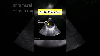 Aortic Dissection and Intramural Hematoma  Echocardiography for Beginners Echo [upl. by Quartis]