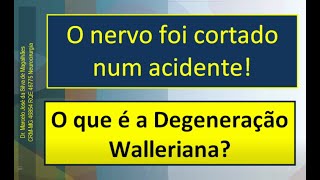 O que é a degeneração Walleriana após a lesão de um nervo DrMarcelo José da Silva de Magalhães [upl. by Lalita]