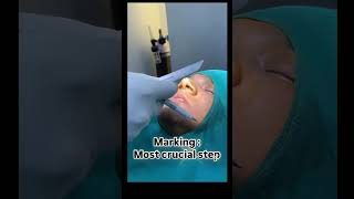 Alarplasty results Best alarplasty surgery in Delhi NCR by Dr Anil kumar kaler Call 8448150908 [upl. by Cida]