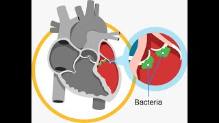 Major and Minor Criteria for Diagnosing Infective Endocarditis [upl. by Kohn]