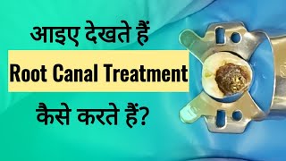 What Is Root Canal Treatment RCT l RCT on Tooth in Hindi [upl. by Eeram]