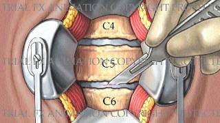 2 Level Cervical Arthrodesis with ProDiscC [upl. by Ttennej75]