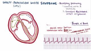 Wolff Parkinson White Syndrome  Osmosis [upl. by Aynam233]