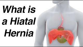 What is a Hiatal Hernia Animation amp How It Causes Reflux [upl. by Schuyler]