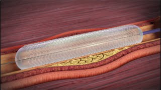 What is a Coronary Angioplasty [upl. by Takken]