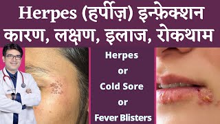 Herpes Infection Of Skin  हर्पीज़ के कारण लक्षण इलाज  Herpes Symptoms Causes Treatment  Hindi [upl. by Morris]