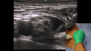 Surgery Samurai  Supraclavicular Brachial Plexus Nerve Block Using ultrasound Guidance [upl. by Nalyt794]