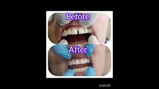 Midline diastema closure [upl. by Ola]