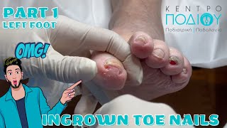 Ingrown ToenailΕίσφρυση όνυχος callus κεντροποδιου footcare podologos podiatrist podiatry [upl. by Elvera700]