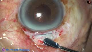 ICCE Intracapsular Cataract Extraction IRIS CLAW IOL implantation amp Ant Vitrectomy  P Mohanta [upl. by Aubigny]