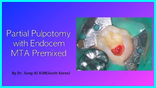 Partial pulpotomy with Endocem MTA Premixed [upl. by Akirdnas]