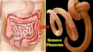 How to Get Rid of Pinworms Overnight  Top 9 Home Remedies for Pinworms During Pregnancy [upl. by Patti]