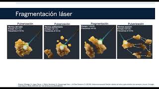 Ureterorrenoscopía flexible litotricia láser fragmentación y pulverización [upl. by Chafee885]