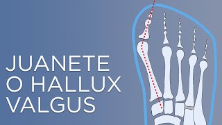 Que es el juanete o hallux valgus causas y tratamiento [upl. by Tu]