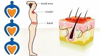 Shingles  The causes symptoms treatment and prevention [upl. by Norvil683]