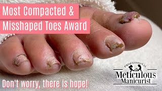 How to Pedicure Transformation the Most Compacted amp Misshapen Toenails [upl. by Desireah764]