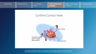 Key screening views of the fetal heart  Part 4  Left ventricular outflow [upl. by Macmahon]