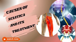 Different Causes of Sciatica and its Treatment [upl. by Earaj]