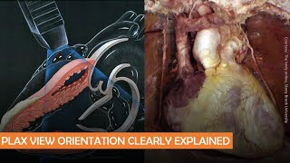 Parasternal long axis echocardiographic view anatomy POCUS pearls  Dr Koratala [upl. by Keese]