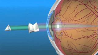 Multifocal Lens IOL [upl. by Leinahtan]