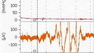 Bupivacaine Cardiotoxicity in an Anesthetized Rat [upl. by Vladamar907]