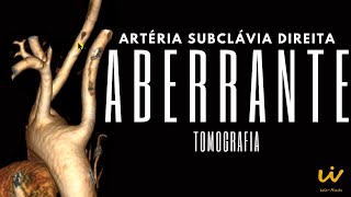 ARTÉRIA SUBCLÁVIA Direita ABERRANTE [upl. by Tallu]