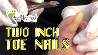 Two Inch Toenails Long Painful Incurvated Nails [upl. by Namwob]