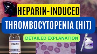 Heparin Induced Thrombocytopenia HIT Types Pathogenesis Diagnosis and Treatment Made Easy [upl. by Cyprian]