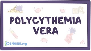 Polycythemia vera  causes symptoms diagnosis treatment pathology [upl. by Olinde]