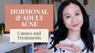 Treating Hormonal Acne  Dermatologist Tips [upl. by Millda]