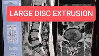 Large Disc Extrusion  MRI of Lumbar Spine on GE 15 Tesla [upl. by Eelarak]