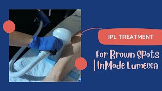 IPL Treatment for Brown Spots  InMode Lumecca  Live [upl. by Casanova72]