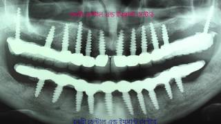 Banasree Dental amp Implant Center [upl. by Charline]