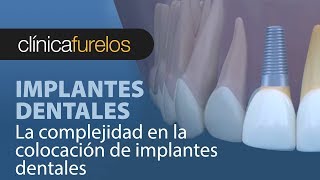 La complejidad en la colocacion de implantes dentales [upl. by Rose]