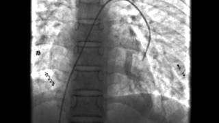 Hereditary Haemorrhagic Telangiectasia [upl. by Yedorb]