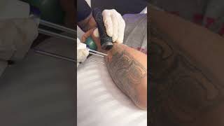 Laser Tattoo Removal with The Ink Eraser tattoo lasertattooremoval laserclinic channel story [upl. by Ahtelahs]