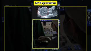 IVF Embryo Transfer IVF treatment for Pregnancy by Dr Rakshita Malik ivfspecialist ivfdoctor [upl. by Mcleod]