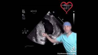 Amyloidosis Cardiomyopathy Echocardiography [upl. by Lanae]