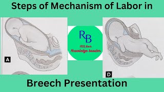 MOL in Breech PresentationRB MCQ Bank Knowledge BoosterGNM 3rd year students [upl. by Aeuhsoj164]