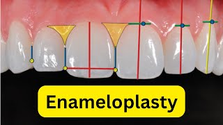 What is enameloplasty or odontoplasty [upl. by Tiga]